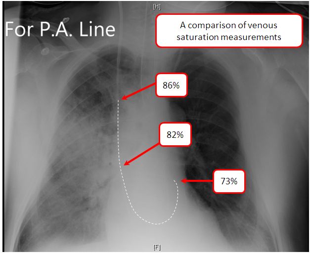 Mixed venous oxygen and carbon dioxide content Deranged Physiology